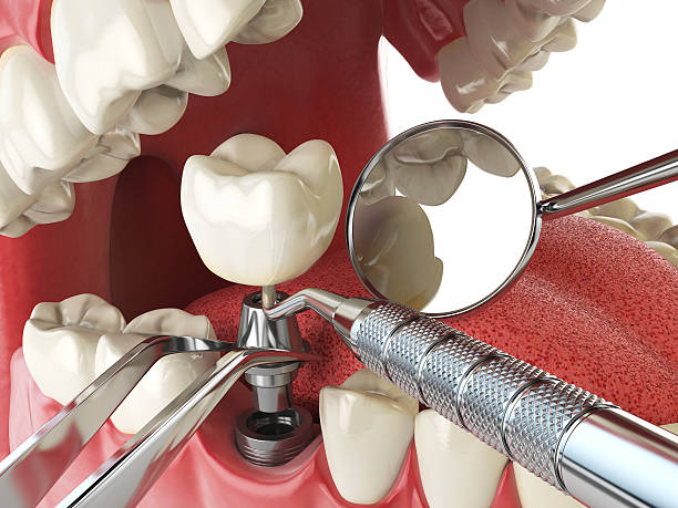 Best Lost Filling or Crown Replacement in Glenwood, GA